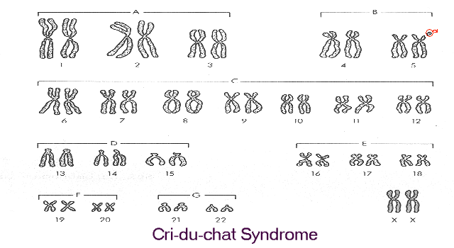 Cri du chat symptoms