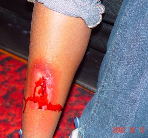 bleeding shin