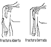 Clasificaci�n de las Fracturas