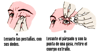 Cuerpo Exta�o en el Ojo