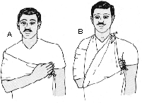 Inmovilizaci�n de Antebrazo