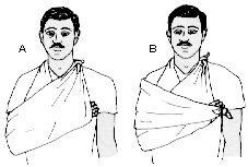 Inmovilizaci�n de Antebrazo