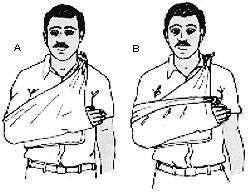 Inmovilizaci�n de Antebrazo