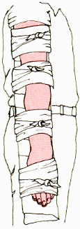 Inmovilizaci�n de brazo