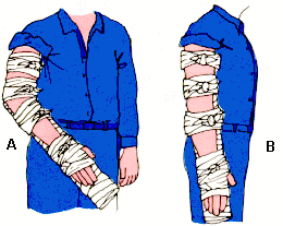 Inmovilizaci�n de brazo