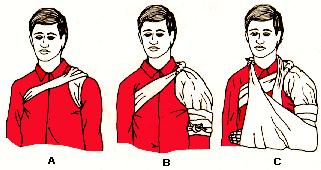 Inmovilizaci�n de Clavicula
