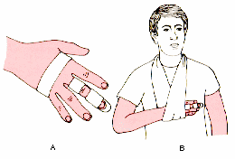 Inmovilizaci�n Dedos