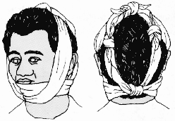 Inmovilizaci�n de Mandibula