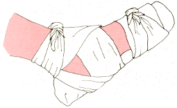 Inmovilizaci�n de Pie