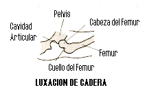 Luxaci�n de Cadera