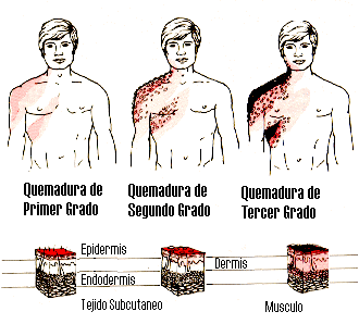 Clasificaci�n de las Quemaduras