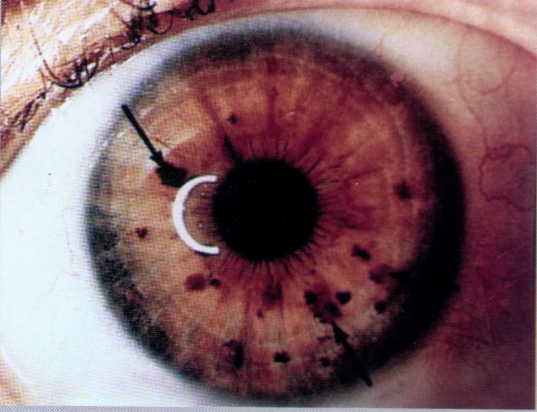 Diagnos Punca Penyakit Melalui Anak Mata (Iridology)
