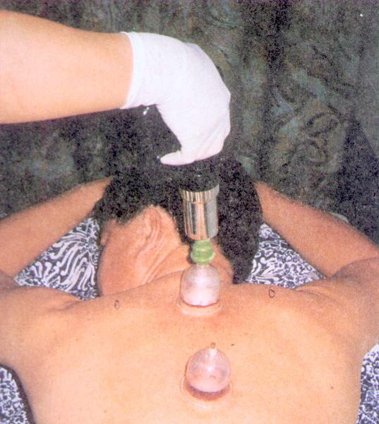 Bekam (Al Hijamah)