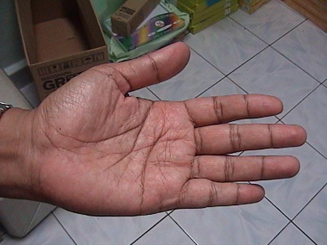 Diagnos Punca Penyakit Melalui Saraf Tapak Tangan