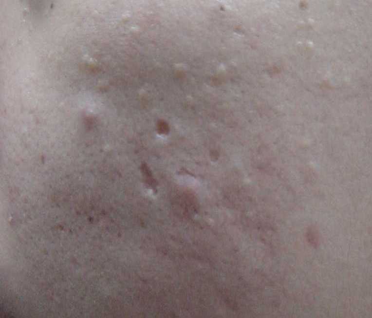 Treat Acne & Reduce scars