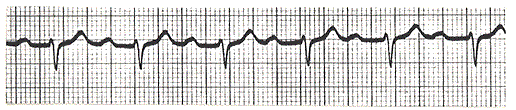ECG - Check the Health of Your Heart