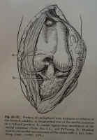 A damaged meniscus.