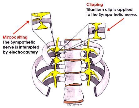 Clipping, t�cnica inventada por un doctor asi�tico