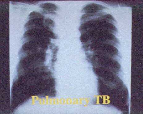 ENTRAR AL INDICE DE TUBERCULOSIS PULMONAR