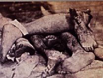 Pile of severed limbs