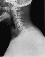 cervical spine x-ray