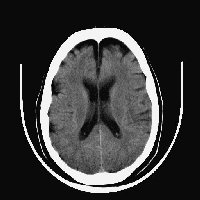 CT of the Head