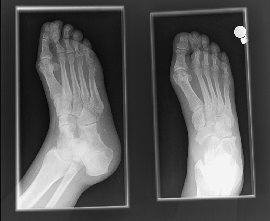 foot x-ray