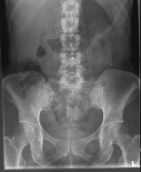 abdomen x-ray