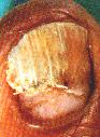 fungal nail