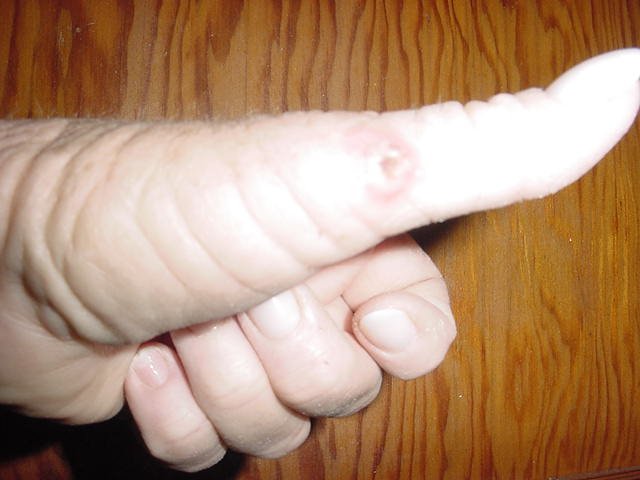 Sore Mouth On A Human