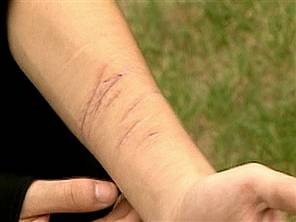 Picture of Self Injury