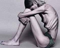 Foto de una mujer anorexica, esta enfermedad es letal.