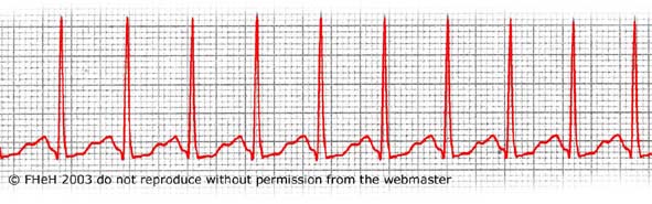 click for more information on this ECG of sinus tachycardia