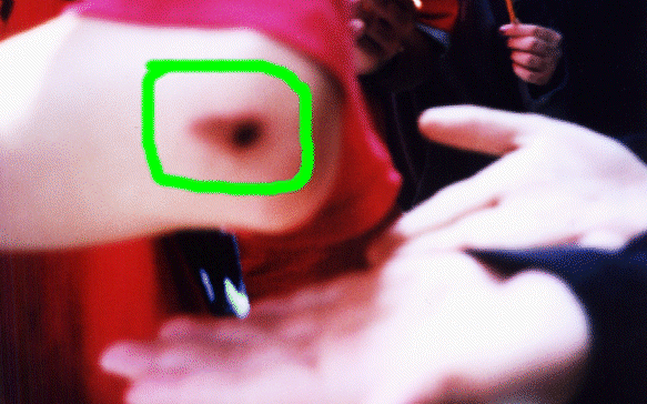 Kyle's scar, caused by the evil actions of the Spork.