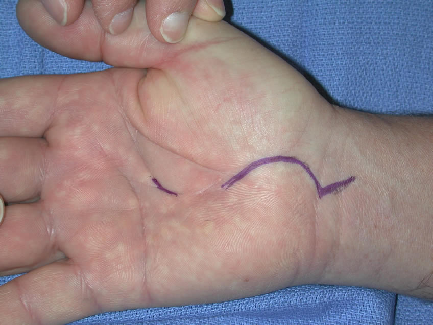 Right Hang Mark-up