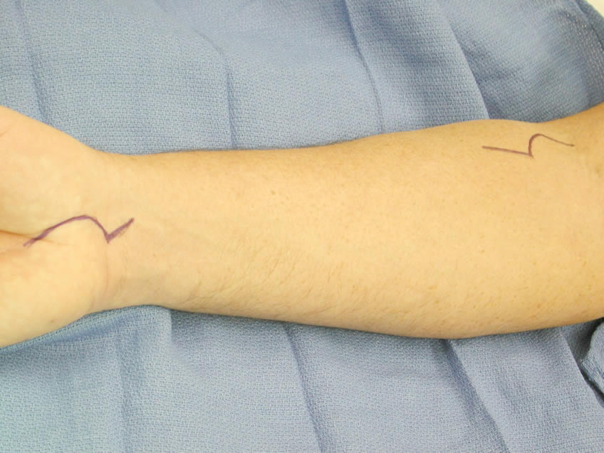 Right Arm Mark-up Extended