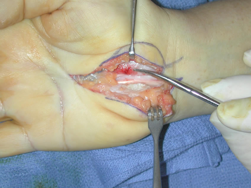 Right Hand Cut Open Prepared