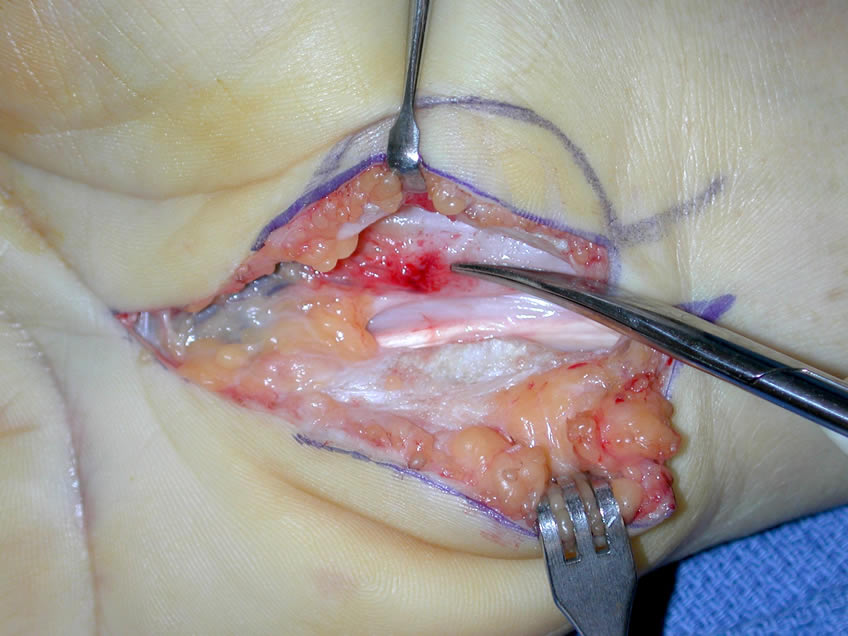 Rt Hand Cut Open/Initial Close View of Damaged Nerve