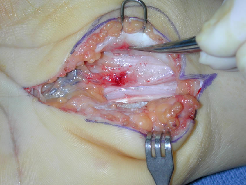 Rt Hand Farther View of Damaged Nerve