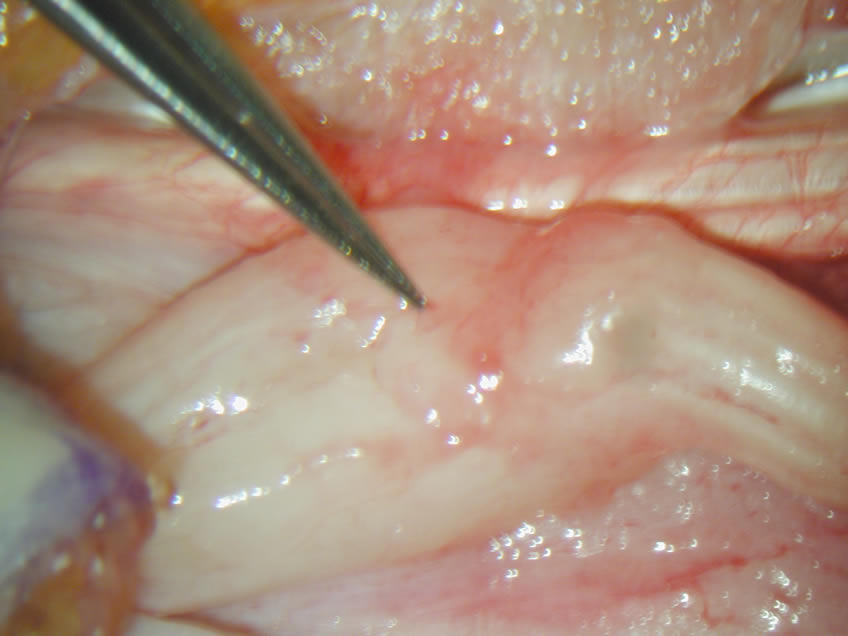 Rt Hand Closer View of Damaged Nerve