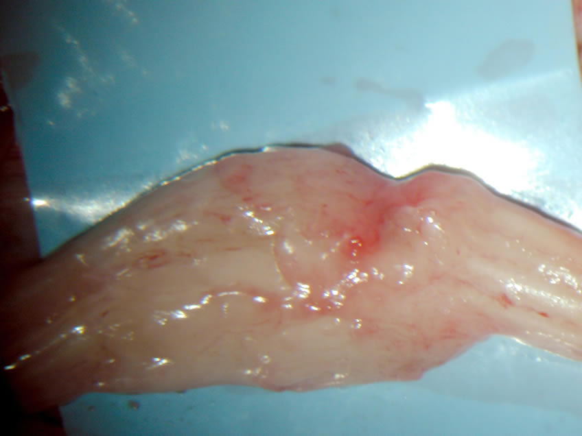 Rt Hand Close-up View of Damaged Nerve