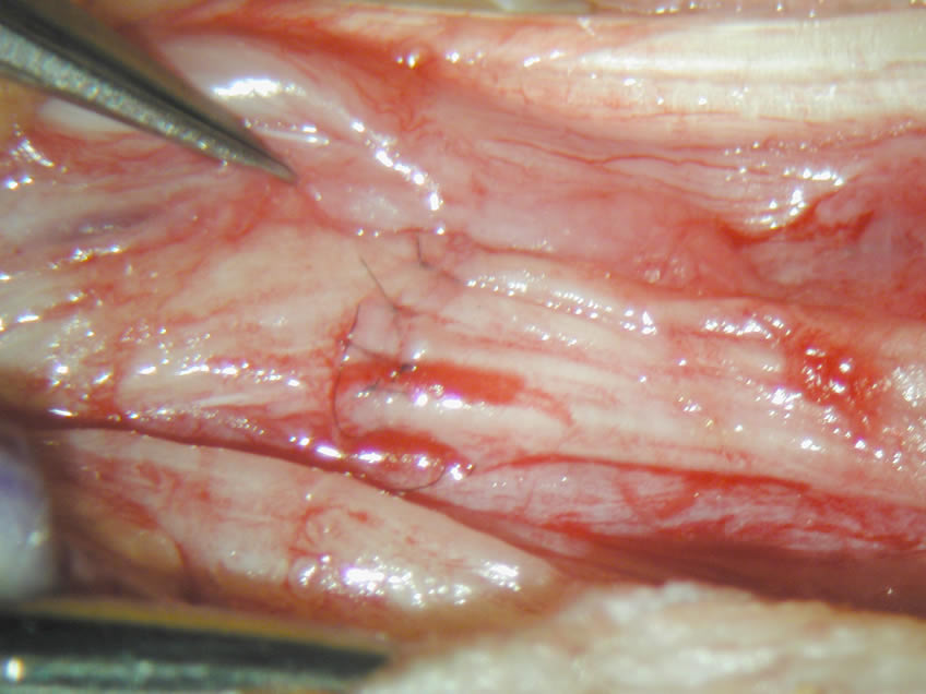 Rt Hand View of Stitched/Repaired Nerve
