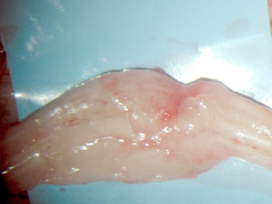 Severed nerve from Dr. Herron's initial CTR surgery.