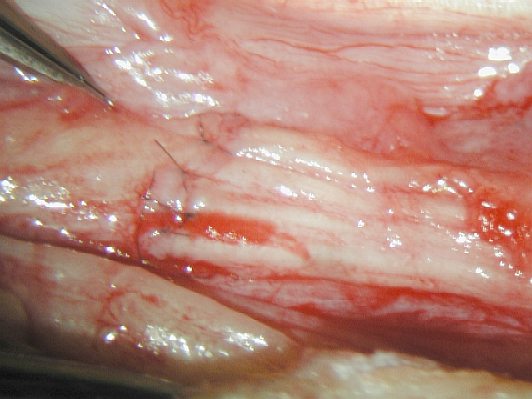 Repaired nerve by Dr. McClinton from initial CTR surgery.