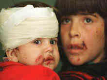 Injured children