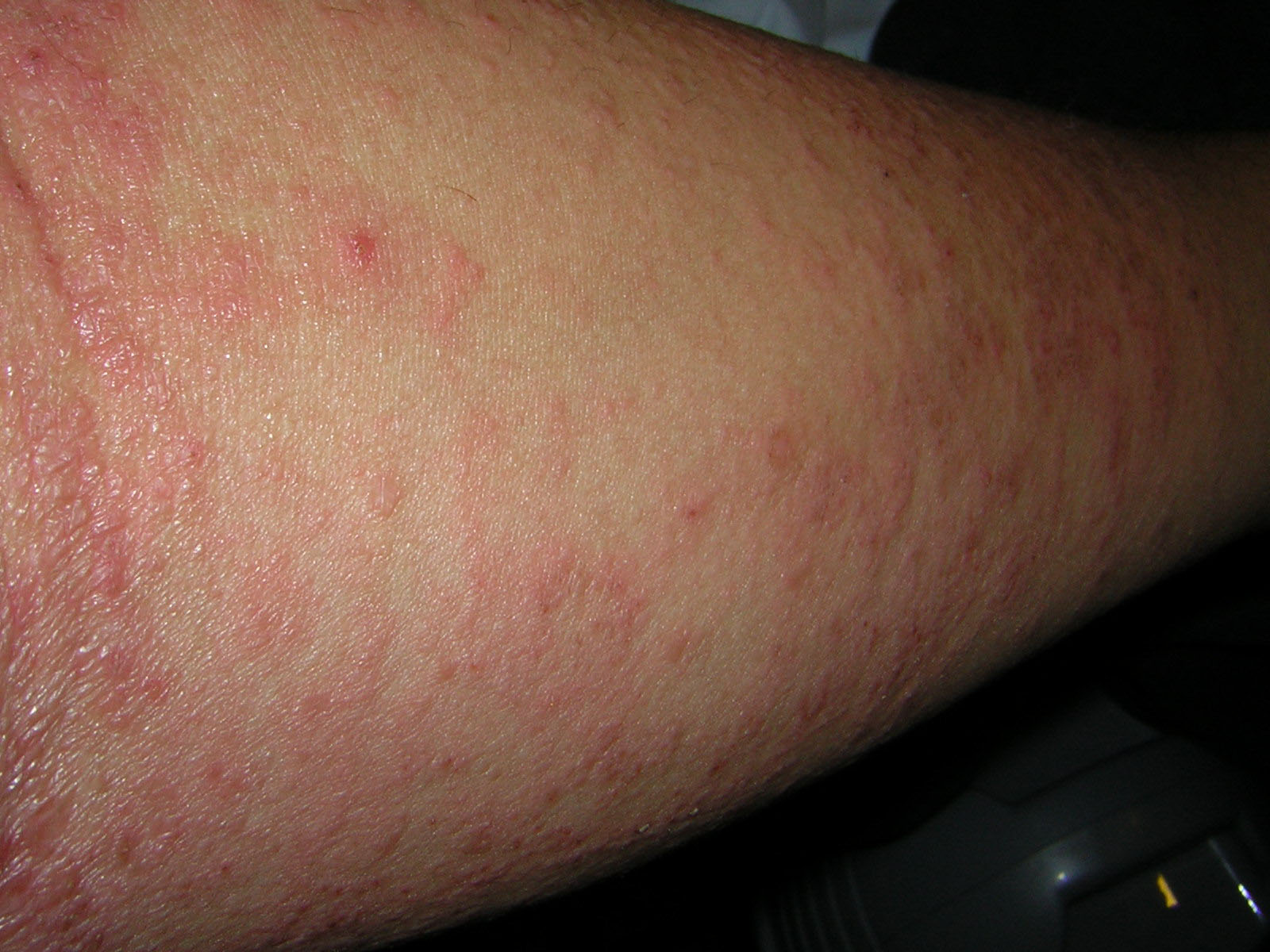 CDC - Scabies - General Information - Frequently Asked ...