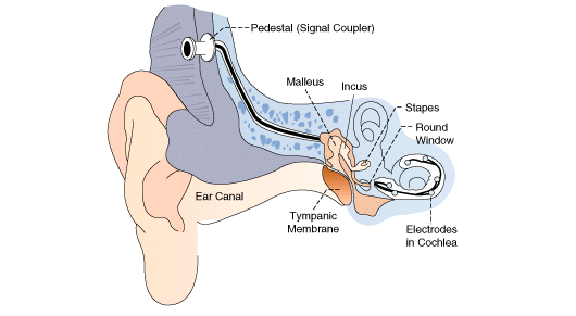 Diagram of Cochlear Implant