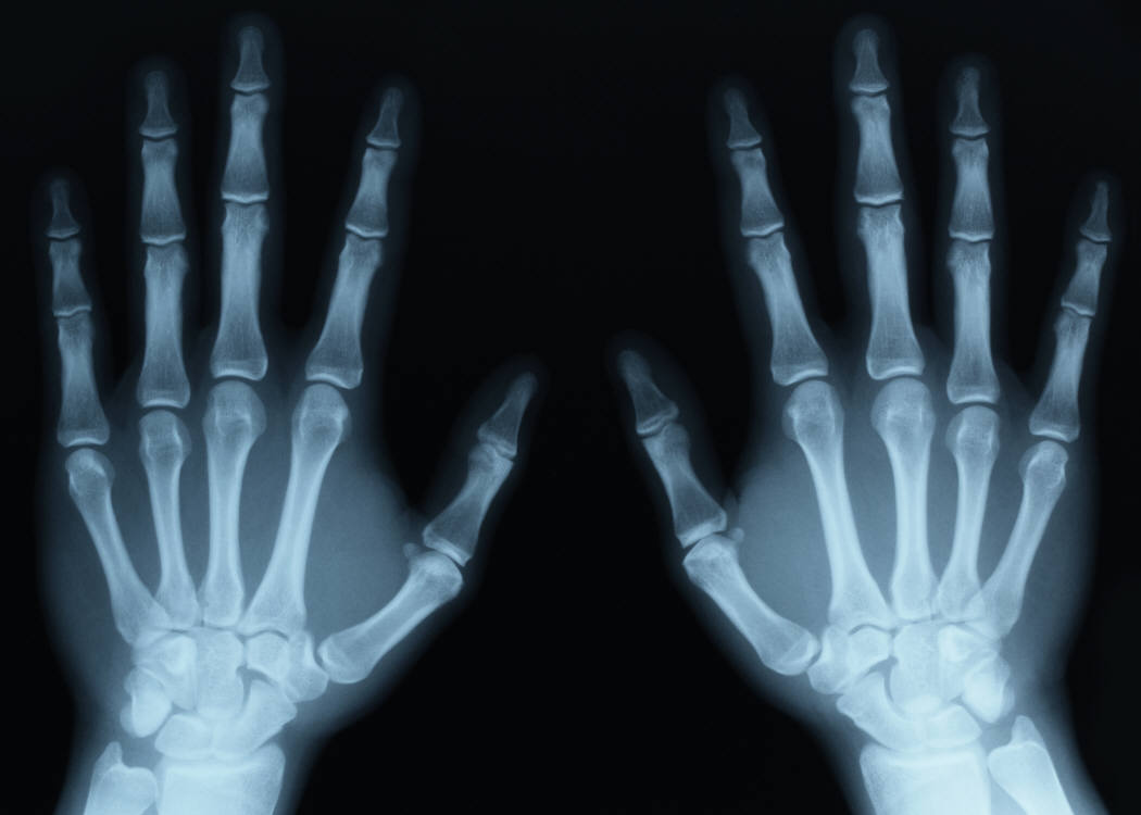 X-Ray