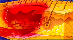 Stage 4 Pressure Ulcers