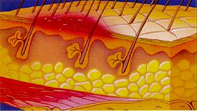 Stage II Pressure Ulcers